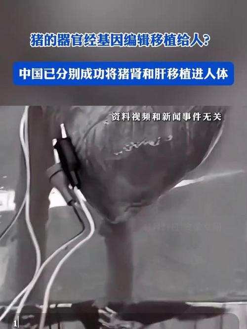 全球首例！中国团队成功将基因编辑猪肝脏移植人体